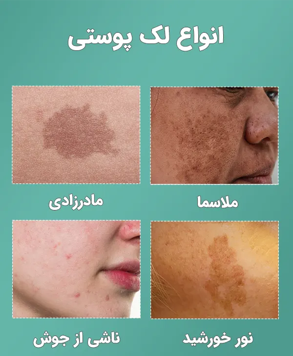 راهنمای جامع درمان لک صورت؛ از علل تا بهترین روش‌های درمانی